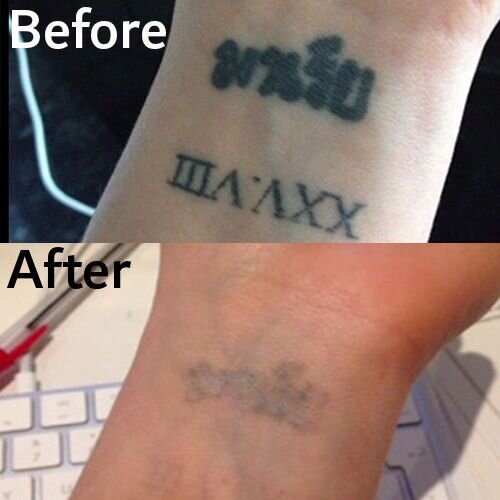image of skin tattoo laser removal 